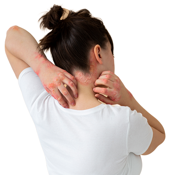 Ready For Psoriasis Relief