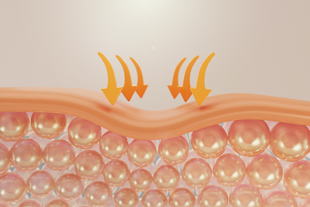 why psoriasis needs consistent skin barrier